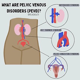 The 3 Rare diseases. These conditions are categorized as vascular compression disorders. 