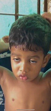 Droopy eyelid