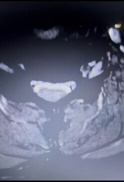 My worst cervical level, C4-C5. No CSF, 0.4 cord compression ratio