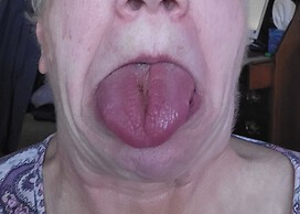 Not sticking out tongue--just pops out