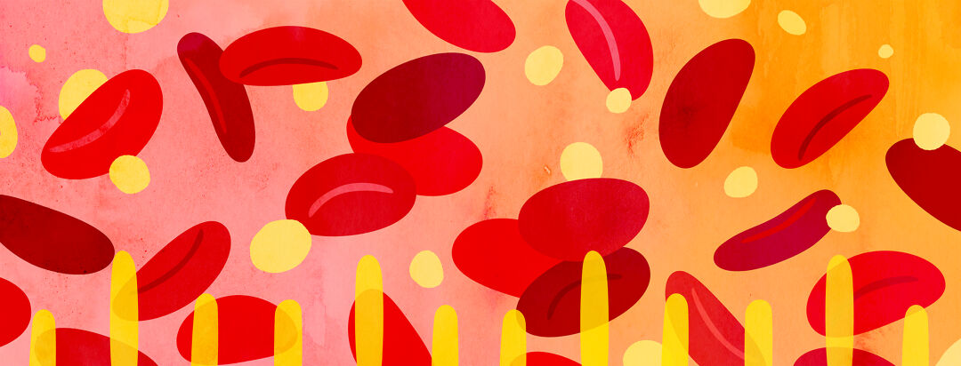 Immune Thrombocytopenia (ITP): What You Need to Know image