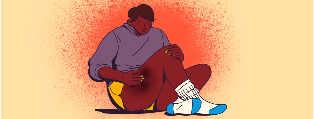 Signs and Symptoms of ITP image